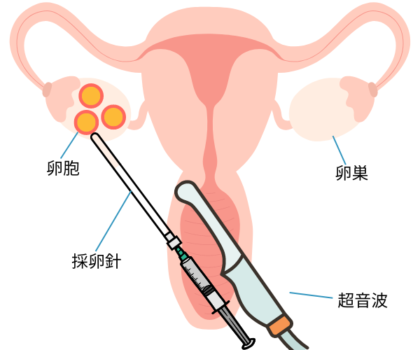 採卵のイメージ